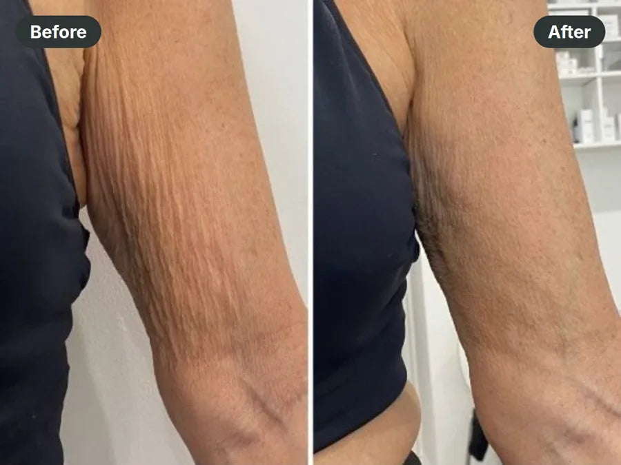 Before and after: crepey skin on the inner arm