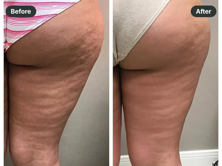Before and after: butt & back of thigh