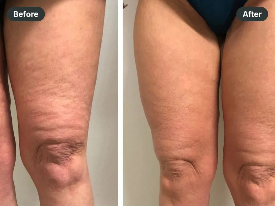 Before and after: above the knee