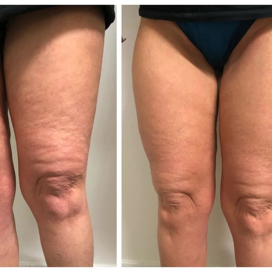 Before and after, front of thighs