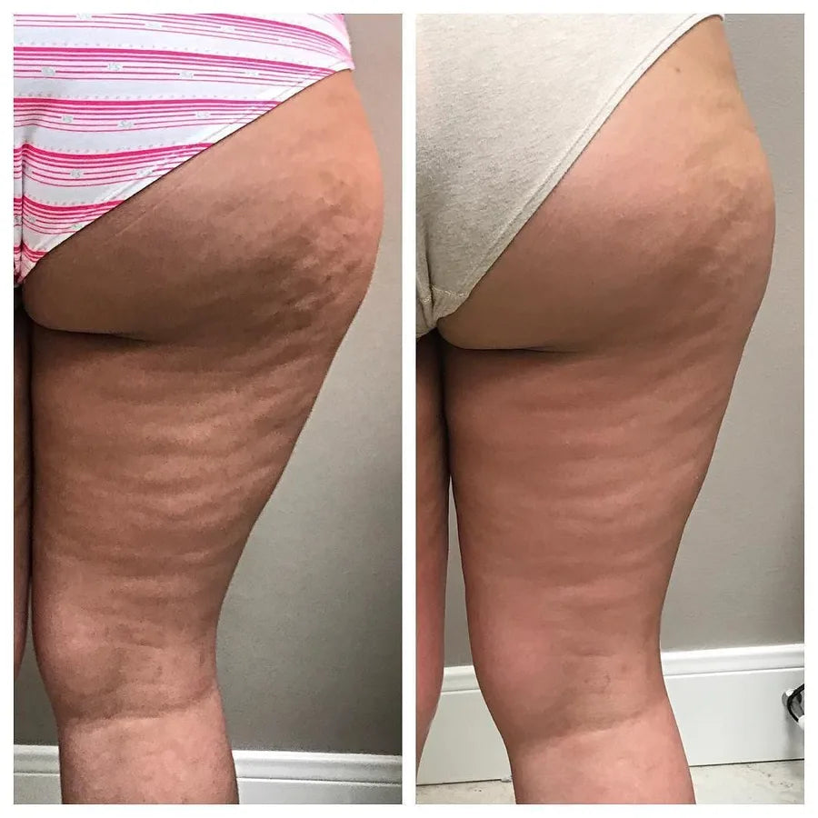 Before and after, back of thighs and butt