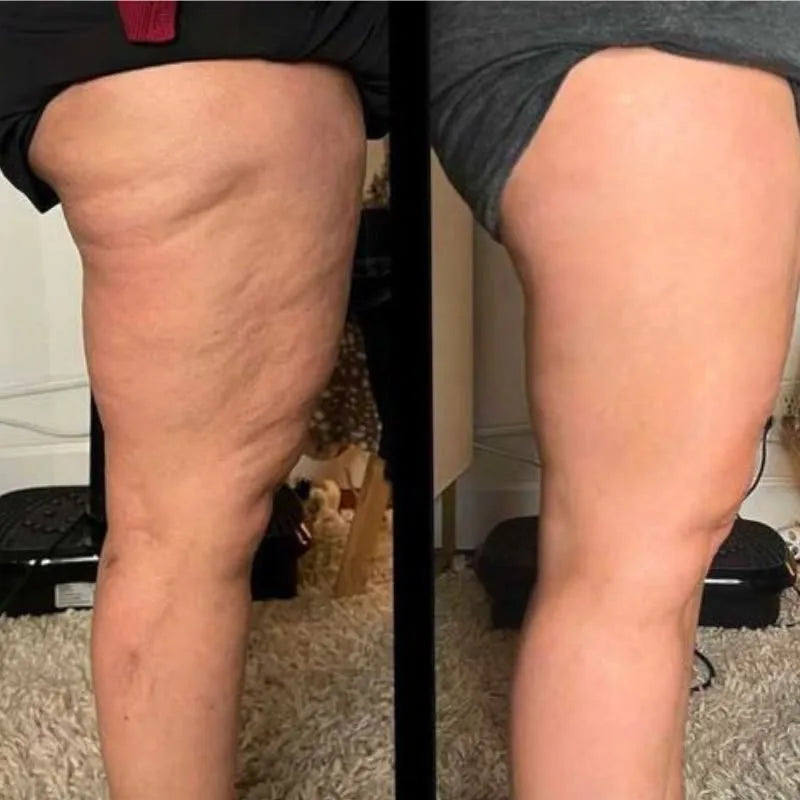 Before and after, side of thigh