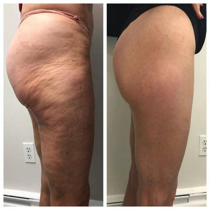 Before and after, butt and hip