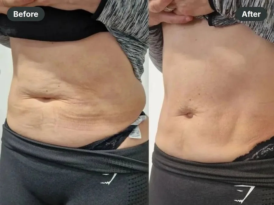 Before and after: loose skin on the belly