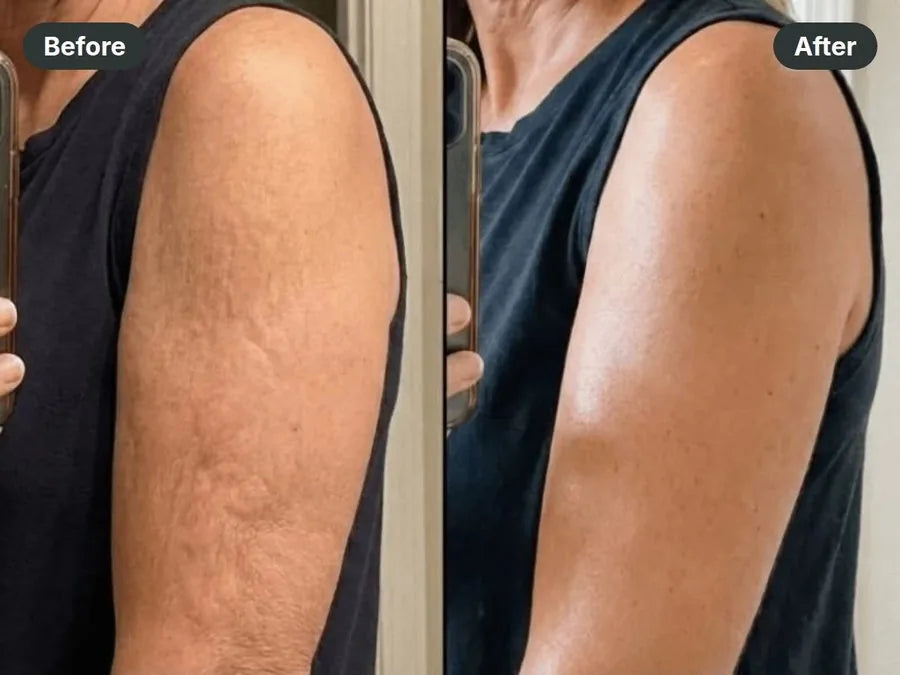 Before and after: upper arm