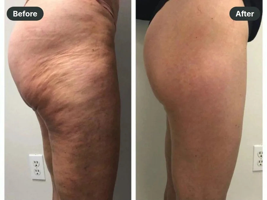 Before and after: butt & outer thigh