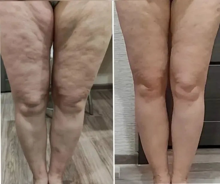 Before and after: front of thighs