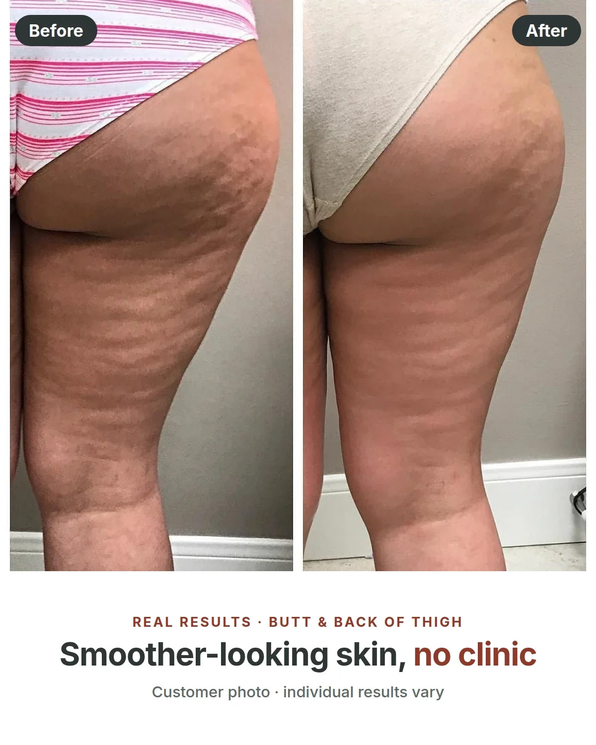 Before and after: butt and back of thigh, smoother-looking skin