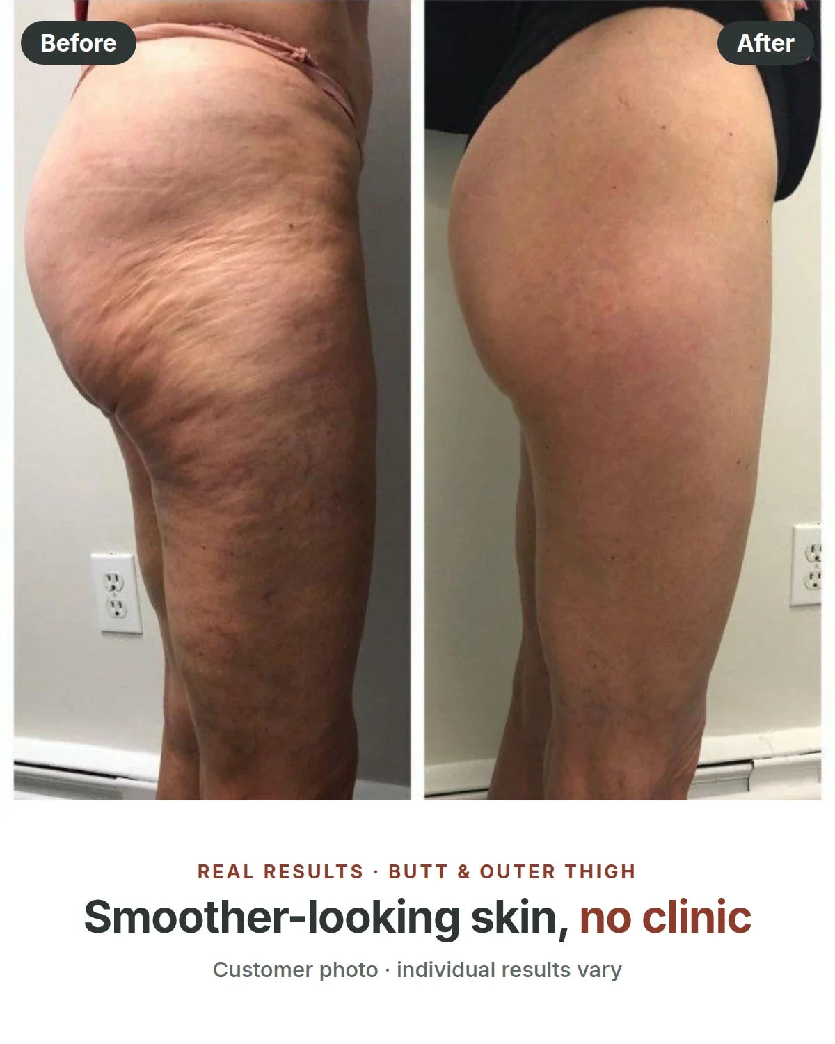 Before and after: butt and outer thigh, smoother-looking skin